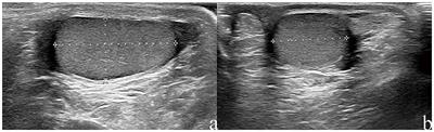 Referential Values of Testicular Volume Measured by Ultrasonography in Normal Children and Adolescents: Z-Score Establishment
